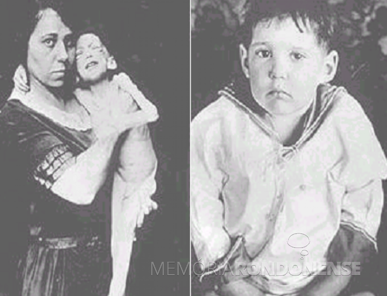 Adolescente Leonard Thompson antes e depois de receber insulina purificada. 
Imagem: Acervo Abev. org. br - FOTO 2 --